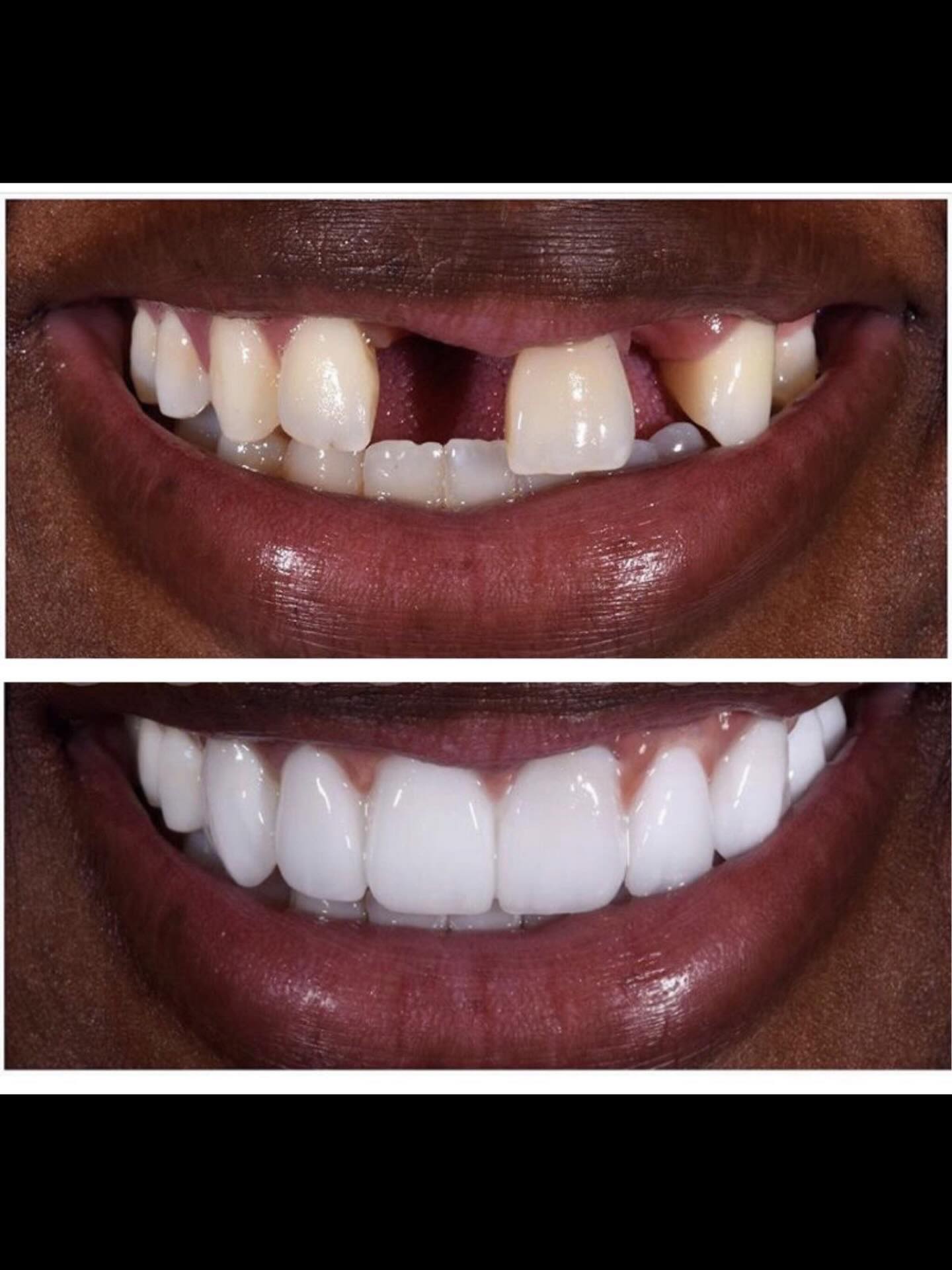 Patient smile result