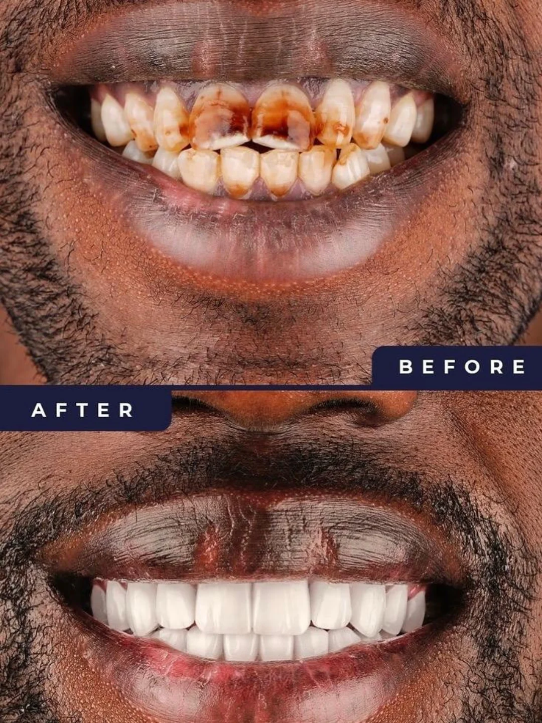 Eight upper porcelain veneers · Lekki