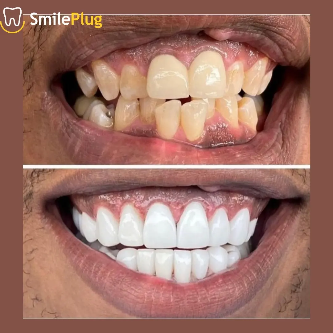 In-clinic whitening, three shades · Ikeja